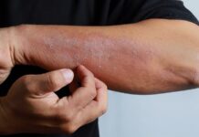 Egzama, yaygın olarak görülen kronik bir cilt hastalığı olup, milyonlarca insanı etkilemektedir. Tıp dilinde “atopik dermatit” olarak da adlandırılan bu durum, özellikle bağışıklık sisteminin aşırı reaksiyonu ile ilişkilidir. Cilt bariyerinin zayıflaması, çevresel etkenlere karşı hassasiyetin artması ve genetik yatkınlık egzamanın gelişiminde başlıca faktörlerdendir. Ancak en belirgin belirtisi kaşıntı, kuruluk ve kızarıklıkla kendini gösteren bir iltihaplanma sürecidir. Bu yazıda egzamanın ne olduğu, neden kaşıntıya yol açtığı ve Türkiye’deki yaygınlığı ele alınacaktır. Konulu bir haber görseli.