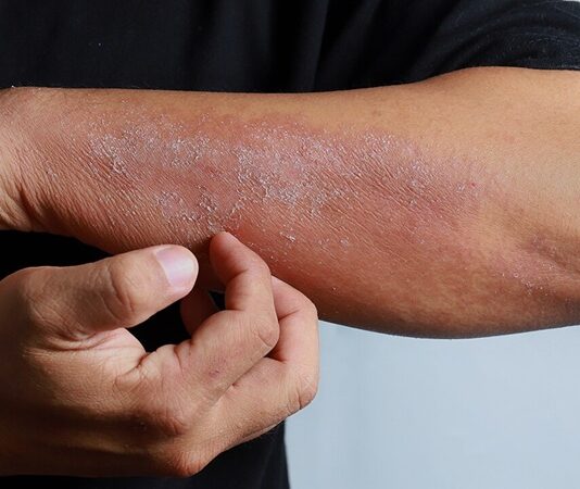 Egzama, yaygın olarak görülen kronik bir cilt hastalığı olup, milyonlarca insanı etkilemektedir. Tıp dilinde “atopik dermatit” olarak da adlandırılan bu durum, özellikle bağışıklık sisteminin aşırı reaksiyonu ile ilişkilidir. Cilt bariyerinin zayıflaması, çevresel etkenlere karşı hassasiyetin artması ve genetik yatkınlık egzamanın gelişiminde başlıca faktörlerdendir. Ancak en belirgin belirtisi kaşıntı, kuruluk ve kızarıklıkla kendini gösteren bir iltihaplanma sürecidir. Bu yazıda egzamanın ne olduğu, neden kaşıntıya yol açtığı ve Türkiye’deki yaygınlığı ele alınacaktır. Konulu bir haber görseli.