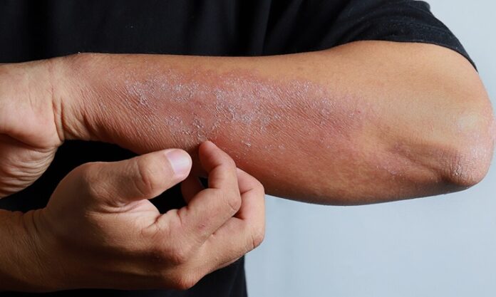 Egzama Nedir Ciltte Kaşıntıya Neden Olur Mu Egzama, yaygın olarak görülen kronik bir cilt hastalığı olup, milyonlarca insanı etkilemektedir. Tıp dilinde “atopik dermatit” olarak da adlandırılan bu durum, özellikle bağışıklık sisteminin aşırı reaksiyonu ile ilişkilidir. Cilt bariyerinin zayıflaması, çevresel etkenlere karşı hassasiyetin artması ve genetik yatkınlık egzamanın gelişiminde başlıca faktörlerdendir. Ancak en belirgin belirtisi kaşıntı, kuruluk ve kızarıklıkla kendini gösteren bir iltihaplanma sürecidir. Bu yazıda egzamanın ne olduğu, neden kaşıntıya yol açtığı ve Türkiye’deki yaygınlığı ele alınacaktır. Konulu bir haber görseli.