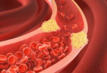 Kolesterol, vücutta bulunan ve vücudun birçok önemli işlevini sürdürebilmesi için gerekli olan bir yağ molekülüdür. Ancak, kolesterolün türü ve seviyeleri, sağlığımız üzerinde büyük bir etkiye sahiptir. Kolesterol seviyelerini değerlendiren önemli terimler arasında HDL ve LDL kolesterol yer alır. Bu iki terim, kalp sağlığı açısından kritik rol oynayan ve doktorların hastalarının kolesterol seviyelerini değerlendirmede kullandığı başlıca göstergelerdir. Bu yazıda, HDL ve LDL kolesterolün ne anlama geldiğini, bunların vücut üzerindeki etkilerini ve nasıl yönetilebileceğini inceleyeceğiz. Konulu bir haber görseli.