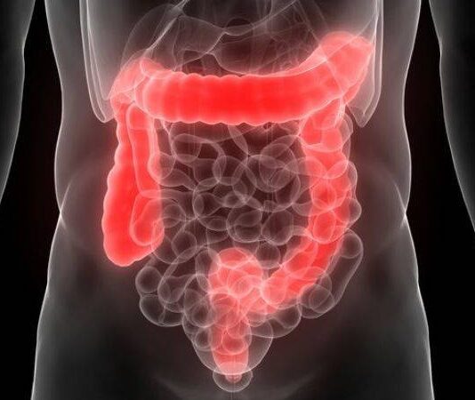 İrritabl Bağırsak Sendromu (IBS), sindirim sistemi üzerinde etkili olan, yaygın bir bağırsak rahatsızlığıdır. Genellikle karın ağrısı, şişkinlik, gaz, ishal ve kabızlık gibi belirtilerle kendini gösterir. IBS, sindirim sistemini etkileyen bir fonksiyonel hastalık olarak tanımlanır; yani bağırsaklarda fiziksel bir anormallik veya organik hastalık yoktur, ancak sindirim sistemi işlevleri bozulur. Bu hastalık, dünya genelinde milyonlarca kişiyi etkiler ve çoğunlukla stres, kötü beslenme, çevresel faktörler gibi etkenlerle tetiklenebilir. IBS, kişilerin yaşam kalitesini önemli ölçüde düşürebilir ve sindirimi etkileyerek vücutta birçok farklı rahatsızlığa yol açabilir. Konulu bir haber görseli.