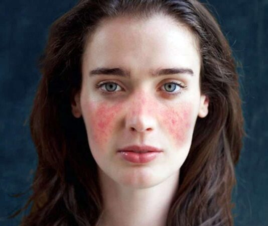 Lupus, bağışıklık sisteminin vücudun kendi dokularına karşı yanlışlıkla savaş açtığı otoimmün bir hastalık olarak bilinir. Bu hastalık özellikle genç kadınlarda görülür ve tüm dünyada milyonlarca insanı etkiler. Bağışıklık sistemi, normalde vücuda dışarıdan giren bakteri, virüs veya zararlı mikroorganizmalara karşı bir savunma mekanizması olarak çalışırken, lupus hastalığında bu sistem kendi organlarını hedef alır. Bu durum çeşitli organ ve dokularda iltihaplanma ve hasara neden olur. Konulu bir haber görseli