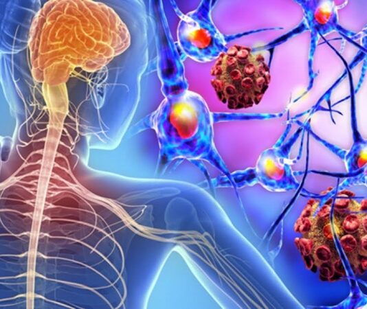 Multipl Skleroz (MS), merkezi sinir sistemini etkileyen ve bağışıklık sisteminin sinir hücrelerine zarar vermesiyle karakterize edilen kronik bir hastalıktır. Beyin ve omurilikteki sinir liflerinin etrafını saran miyelin kılıfının tahrip olmasıyla oluşan bu durum, bilgi akışının kesintiye uğramasına ve ciddi nörolojik sorunlara yol açar. Hastalık, genellikle genç erişkinlerde başlar ve yaşam boyu sürebilir. Erken tanı ve uygun tedaviyle hastalığın etkileri azaltılabilmektedir. Konulu bir haber görseli.