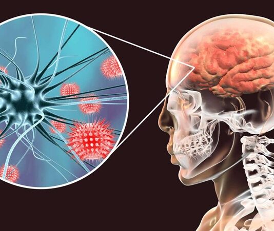 Menenjit, beyin ve omuriliği çevreleyen zarların iltihaplanmasıyla oluşan bir hastalıktır. Bu durum, genellikle bakteriyel, virüs veya fungal enfeksiyonlar sonucunda meydana gelir ve hayati tehlike oluşturabilecek bir sağlık sorunu olarak kabul edilir. Menenjit belirtileri hızla ortaya çıkabileceği için erken tanı ve tedavi büyük önem taşır. Bu yazıda, menenjitin ne olduğunu, belirtilerini, nasıl teşhis edilebileceğini ve erken tanının neden bu kadar kritik olduğunu ele alacağız. Konulu bir haber görseli.