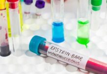 Mononükleoz, halk arasında “öpücük hastalığı” olarak da bilinen ve genellikle Epstein-Barr virüsü (EBV) nedeniyle ortaya çıkan bulaşıcı bir hastalıktır. Bu hastalık çoğunlukla genç bireylerde görülür ve özellikle ergenlik dönemindeki kişiler arasında yaygınlık kazanır. Bu yaygınlığın birçok biyolojik, davranışsal ve çevresel nedeni bulunmaktadır. Bağışıklık sistemi, hijyen koşulları, sosyal alışkanlıklar ve vücut direnci, hastalığın görülme sıklığını etkileyen başlıca faktörler arasındadır. Konulu bir haber görseli.