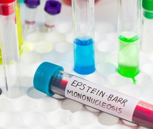 Mononükleoz, halk arasında “öpücük hastalığı” olarak da bilinen ve genellikle Epstein-Barr virüsü (EBV) nedeniyle ortaya çıkan bulaşıcı bir hastalıktır. Bu hastalık çoğunlukla genç bireylerde görülür ve özellikle ergenlik dönemindeki kişiler arasında yaygınlık kazanır. Bu yaygınlığın birçok biyolojik, davranışsal ve çevresel nedeni bulunmaktadır. Bağışıklık sistemi, hijyen koşulları, sosyal alışkanlıklar ve vücut direnci, hastalığın görülme sıklığını etkileyen başlıca faktörler arasındadır. Konulu bir haber görseli.