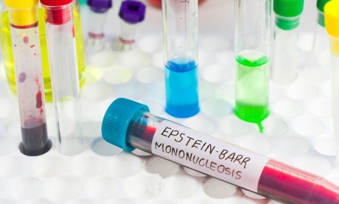 Mononükleoz, halk arasında “öpücük hastalığı” olarak da bilinen ve genellikle Epstein-Barr virüsü (EBV) nedeniyle ortaya çıkan bulaşıcı bir hastalıktır. Bu hastalık çoğunlukla genç bireylerde görülür ve özellikle ergenlik dönemindeki kişiler arasında yaygınlık kazanır. Bu yaygınlığın birçok biyolojik, davranışsal ve çevresel nedeni bulunmaktadır. Bağışıklık sistemi, hijyen koşulları, sosyal alışkanlıklar ve vücut direnci, hastalığın görülme sıklığını etkileyen başlıca faktörler arasındadır. Konulu bir haber görseli.