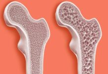 Sessiz ilerleyen ve genellikle kırıklarla fark edilen osteoporoz, kemiklerin yoğunluğunu kaybederek zayıflaması ve kırılgan hale gelmesiyle karakterize edilen bir kemik hastalığıdır. Özellikle ileri yaşta görülen bu hastalık, kadınlarda erkeklere oranla çok daha sık rastlanır. Kadınların yaşam boyu kemik sağlığını etkileyen biyolojik ve hormonal faktörleri, osteoporozun gelişiminde belirleyici rol oynar. Genellikle belirti vermeyen bu hastalık, fark edilmediğinde ciddi sağlık problemlerine yol açabilir. Bu nedenle osteoporoz hakkında bilinçlenmek ve erken önlem almak, bireysel sağlığın korunmasında oldukça önemlidir. Konulu bir haber görseli.