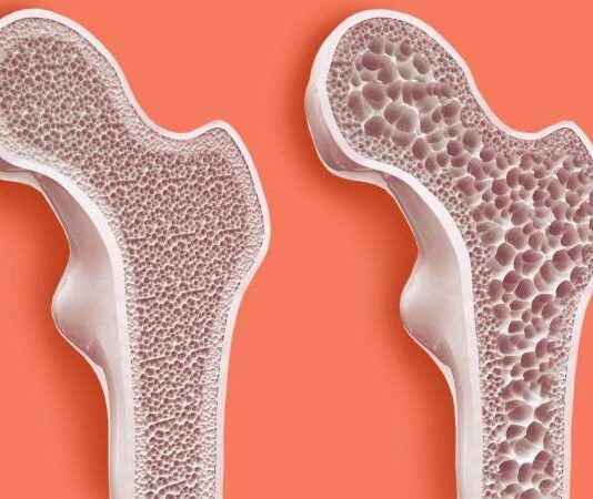 Sessiz ilerleyen ve genellikle kırıklarla fark edilen osteoporoz, kemiklerin yoğunluğunu kaybederek zayıflaması ve kırılgan hale gelmesiyle karakterize edilen bir kemik hastalığıdır. Özellikle ileri yaşta görülen bu hastalık, kadınlarda erkeklere oranla çok daha sık rastlanır. Kadınların yaşam boyu kemik sağlığını etkileyen biyolojik ve hormonal faktörleri, osteoporozun gelişiminde belirleyici rol oynar. Genellikle belirti vermeyen bu hastalık, fark edilmediğinde ciddi sağlık problemlerine yol açabilir. Bu nedenle osteoporoz hakkında bilinçlenmek ve erken önlem almak, bireysel sağlığın korunmasında oldukça önemlidir. Konulu bir haber görseli.