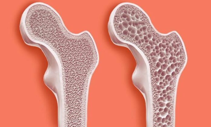 Sessiz ilerleyen ve genellikle kırıklarla fark edilen osteoporoz, kemiklerin yoğunluğunu kaybederek zayıflaması ve kırılgan hale gelmesiyle karakterize edilen bir kemik hastalığıdır. Özellikle ileri yaşta görülen bu hastalık, kadınlarda erkeklere oranla çok daha sık rastlanır. Kadınların yaşam boyu kemik sağlığını etkileyen biyolojik ve hormonal faktörleri, osteoporozun gelişiminde belirleyici rol oynar. Genellikle belirti vermeyen bu hastalık, fark edilmediğinde ciddi sağlık problemlerine yol açabilir. Bu nedenle osteoporoz hakkında bilinçlenmek ve erken önlem almak, bireysel sağlığın korunmasında oldukça önemlidir. Konulu bir haber görseli.