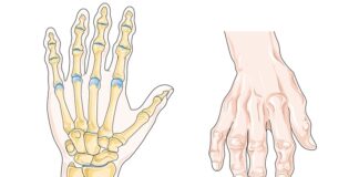 Romatoid Artrit Nedir Eklemlerde Neden Ağrı Yapar Romatoid artrit, vücudun bağışıklık sisteminin kendi dokularına saldırmasıyla oluşan kronik ve ilerleyici bir eklem hastalığıdır. Bu hastalık, özellikle küçük eklemleri hedef alır ve zamanla iltihap, şişlik, hareket kısıtlılığı ve ağrıya neden olur. Romatoid artrit, diğer artrit türlerinden farklı olarak hem eklemlerde hem de tüm vücutta yorgunluk, halsizlik gibi sistemik belirtiler gösterebilir. Kadınlarda erkeklere oranla daha sık görülür ve genellikle 30 ila 60 yaş arasında başlar. Konulu bir haber görseli.