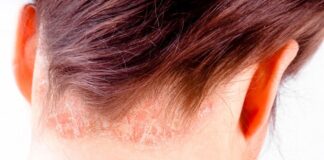 Sedef hastalığı, tıbbi adıyla psoriasis, bağışıklık sisteminin yanlış sinyaller göndermesi sonucu deride meydana gelen kronik ve iltihaplı bir cilt hastalığıdır. Her yaş grubunda görülebilmekle birlikte genellikle genç erişkinlik döneminde ortaya çıkar. Toplumun yaklaşık %2 ila %3’lük bir kesimini etkileyen bu hastalık, kişiden kişiye farklılık gösteren klinik belirtilerle seyredebilir. Ancak pek çok hasta ve hasta yakını, en çok "sedef hastalığı deride kalıcı iz bırakır mı?" sorusunun cevabını merak etmektedir. Bu haberimizde, sedef hastalığının neden olduğu deri lezyonlarının iyileşme sürecinden, iz bırakma olasılığına kadar birçok detaya yer veriyoruz. Konulu bir haber görseli.