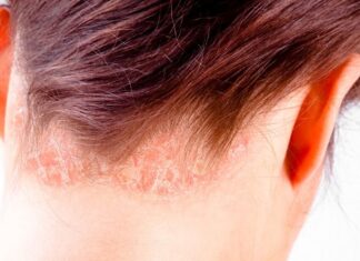 Sedef hastalığı, tıbbi adıyla psoriasis, bağışıklık sisteminin yanlış sinyaller göndermesi sonucu deride meydana gelen kronik ve iltihaplı bir cilt hastalığıdır. Her yaş grubunda görülebilmekle birlikte genellikle genç erişkinlik döneminde ortaya çıkar. Toplumun yaklaşık %2 ila %3’lük bir kesimini etkileyen bu hastalık, kişiden kişiye farklılık gösteren klinik belirtilerle seyredebilir. Ancak pek çok hasta ve hasta yakını, en çok "sedef hastalığı deride kalıcı iz bırakır mı?" sorusunun cevabını merak etmektedir. Bu haberimizde, sedef hastalığının neden olduğu deri lezyonlarının iyileşme sürecinden, iz bırakma olasılığına kadar birçok detaya yer veriyoruz. Konulu bir haber görseli.