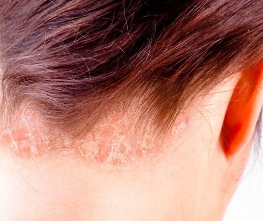 Sedef hastalığı, tıbbi adıyla psoriasis, bağışıklık sisteminin yanlış sinyaller göndermesi sonucu deride meydana gelen kronik ve iltihaplı bir cilt hastalığıdır. Her yaş grubunda görülebilmekle birlikte genellikle genç erişkinlik döneminde ortaya çıkar. Toplumun yaklaşık %2 ila %3’lük bir kesimini etkileyen bu hastalık, kişiden kişiye farklılık gösteren klinik belirtilerle seyredebilir. Ancak pek çok hasta ve hasta yakını, en çok "sedef hastalığı deride kalıcı iz bırakır mı?" sorusunun cevabını merak etmektedir. Bu haberimizde, sedef hastalığının neden olduğu deri lezyonlarının iyileşme sürecinden, iz bırakma olasılığına kadar birçok detaya yer veriyoruz. Konulu bir haber görseli.