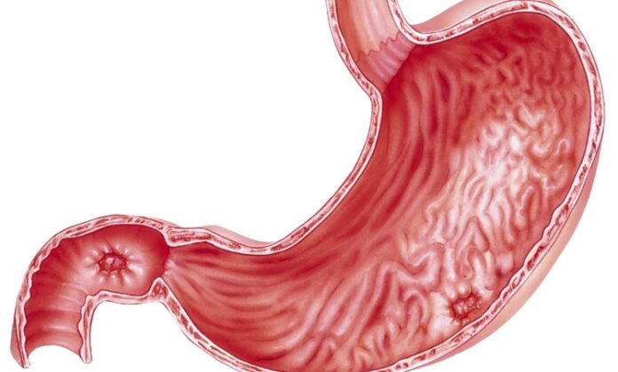 Ülser Nedir Stresle Gerçekten Bağlantısı Var Mı Ülser, mide ya da on iki parmak bağırsağında meydana gelen, genellikle ağrılı, iltihaplı yaralardır. Sindirim sistemi üzerinde önemli etkiler yaratabilen bu rahatsızlık, özellikle yemek sonrası mide asidinin etkisiyle artan ağrılarla kendini gösterir. Ülserin başlıca nedeni, mide asidinin aşırı üretimi ve bu asidin, sindirim organlarının koruyucu yüzeyine zarar vermesidir. Ancak son yıllarda yapılan araştırmalar, stresin de ülserin gelişmesinde önemli bir faktör olabileceğini göstermektedir. Bu haberimizde, ülserin ne olduğunu, nasıl geliştiğini ve stres ile olan bağlantısını inceleyeceğiz. Konulu bir haber detayı.