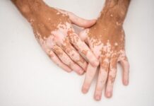 Vitiligo, ciltteki melanin pigmentinin kaybı sonucu ortaya çıkan bir cilt hastalığıdır. Bu durum, genellikle açık beyaz renkte yamalar şeklinde belirir ve farklı boyutlarda olabilir. Özellikle yüz, el, kol, bacak gibi vücudun açıkta kalan bölgelerinde daha belirgin hale gelir. Genetik yatkınlıkla bağlantılı olabileceği gibi bağışıklık sistemiyle ilgili bozukluklar da hastalığın ortaya çıkmasında etkili olabilir. Her ne kadar vitiligo doğrudan fiziksel bir ağrıya yol açmasa da, sosyal ve psikolojik etkileri oldukça derin olabilir. Bu nedenle hem hastalığın tanımı hem de neden oluştuğu, kimlerde görüldüğü gibi konular kamuoyunun sıkça merak ettiği başlıklardan biridir. Konulu bir haber görseli.