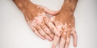 Vitiligo, ciltteki melanin pigmentinin kaybı sonucu ortaya çıkan bir cilt hastalığıdır. Bu durum, genellikle açık beyaz renkte yamalar şeklinde belirir ve farklı boyutlarda olabilir. Özellikle yüz, el, kol, bacak gibi vücudun açıkta kalan bölgelerinde daha belirgin hale gelir. Genetik yatkınlıkla bağlantılı olabileceği gibi bağışıklık sistemiyle ilgili bozukluklar da hastalığın ortaya çıkmasında etkili olabilir. Her ne kadar vitiligo doğrudan fiziksel bir ağrıya yol açmasa da, sosyal ve psikolojik etkileri oldukça derin olabilir. Bu nedenle hem hastalığın tanımı hem de neden oluştuğu, kimlerde görüldüğü gibi konular kamuoyunun sıkça merak ettiği başlıklardan biridir. Konulu bir haber görseli.