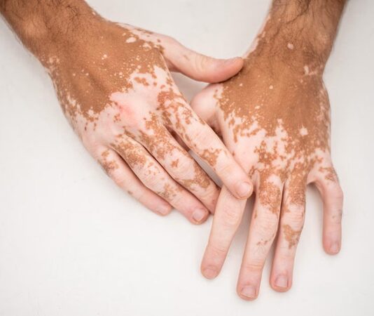 Vitiligo, ciltteki melanin pigmentinin kaybı sonucu ortaya çıkan bir cilt hastalığıdır. Bu durum, genellikle açık beyaz renkte yamalar şeklinde belirir ve farklı boyutlarda olabilir. Özellikle yüz, el, kol, bacak gibi vücudun açıkta kalan bölgelerinde daha belirgin hale gelir. Genetik yatkınlıkla bağlantılı olabileceği gibi bağışıklık sistemiyle ilgili bozukluklar da hastalığın ortaya çıkmasında etkili olabilir. Her ne kadar vitiligo doğrudan fiziksel bir ağrıya yol açmasa da, sosyal ve psikolojik etkileri oldukça derin olabilir. Bu nedenle hem hastalığın tanımı hem de neden oluştuğu, kimlerde görüldüğü gibi konular kamuoyunun sıkça merak ettiği başlıklardan biridir. Konulu bir haber görseli.